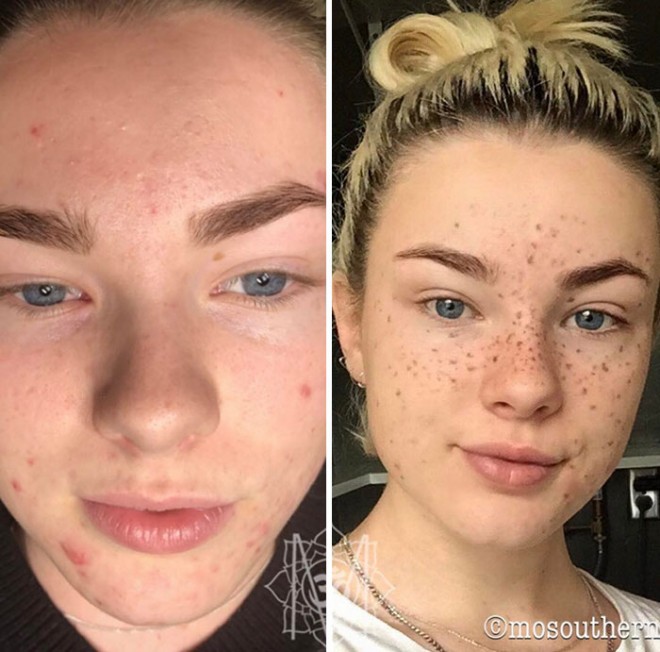 Gözəllik dünyasının yeni trendi – çilli üzlər