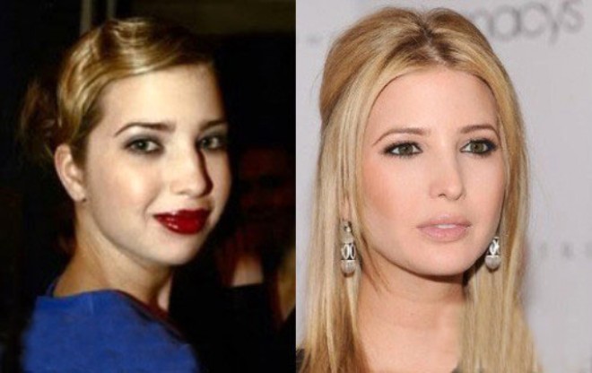 İvanka Trampın estetik əməliyyatsız halı – fotolar