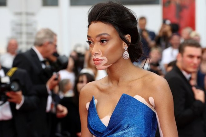 Dəri xəstəliyindən əziyyət çəkən fotomodel film premyerasına qatıldı - fotolar