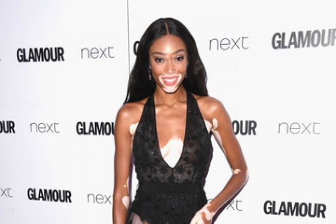 Dəri xəstəliyindən əziyyət çəkən model tədbirdə - foto