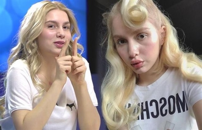 Aleyna dodağına slikon etdirib?