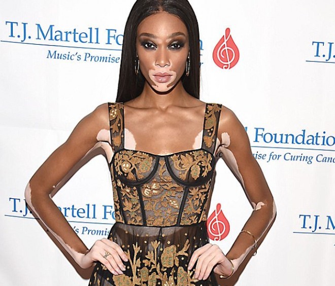 Vitiliqo xəstəliyindən əziyyət çəkən model şəffaf libasda - foto&nbsp;