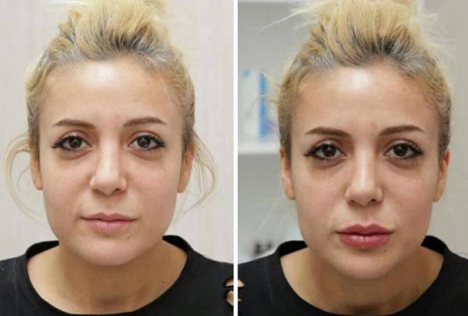 Müğənni dodaqlarını şişirdib
