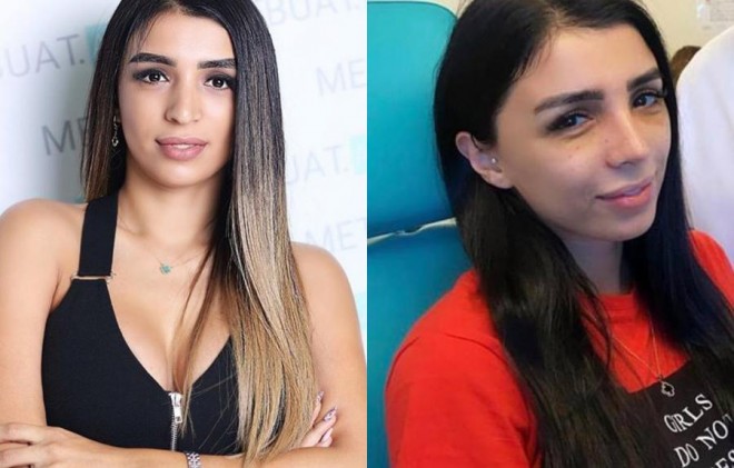 Rəqqasə Renka burnunu kəsdirdi