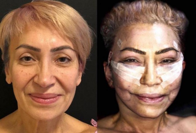 Nahidə plastik əməliyyat etdirdi - video