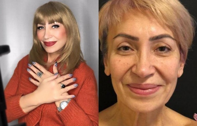 Əməkdar artist əməliyyatdan sonra - foto