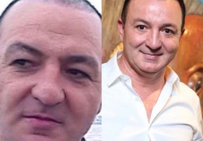 Vasif Məhərrəmli saç əkdirdimi?