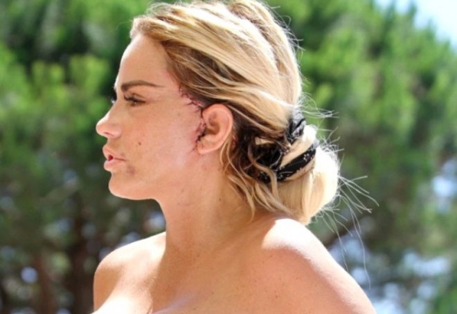 Müğənni və model üzünü dartırdı - foto