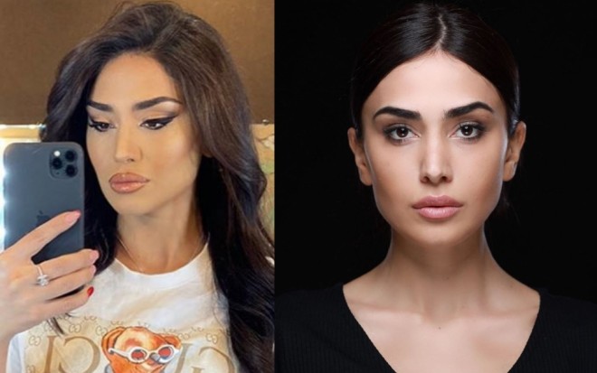 Pərvin estetik müdaxilə etdirdi - foto