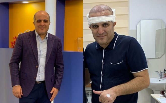 &nbsp;Eldəniz başına tük əkdirdi - foto