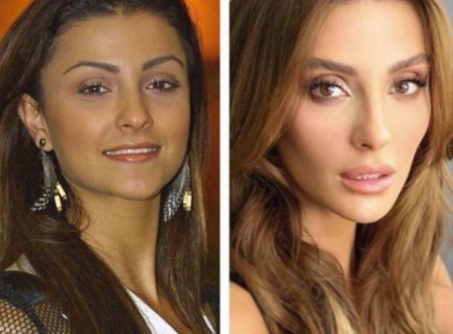 Model plastik əməliyyat etdirdi