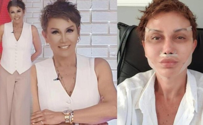 Estetik əməliyyatdan sonra danışa bilmədi