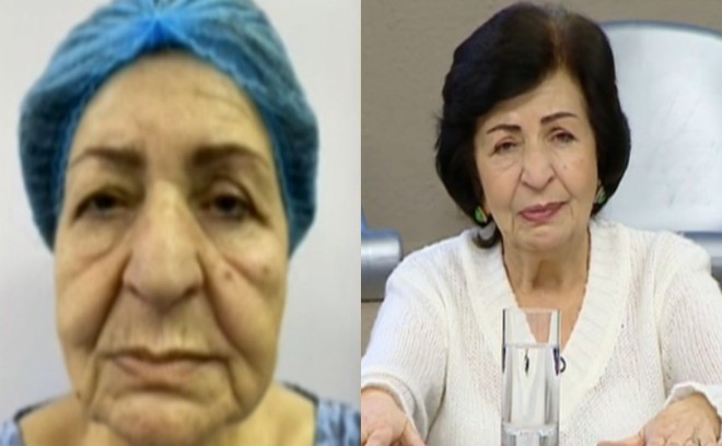 Əməkdar artist 15 yaş cavanlaşıb