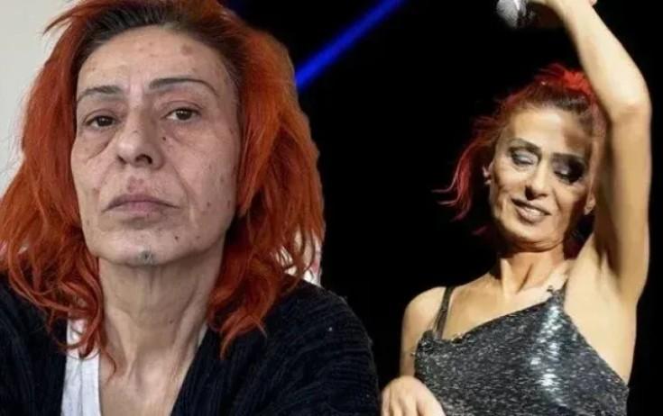 Müğənninin üzü yanıb - FOTO